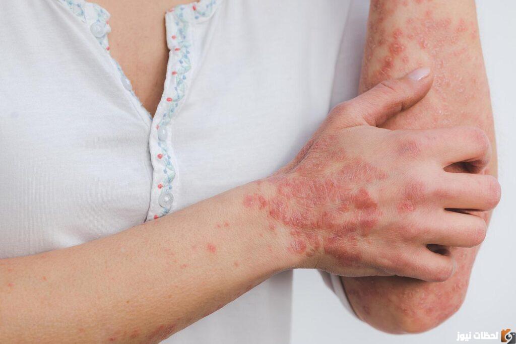 من هنا.. طرق طبيعية بالأعشاب لعلاج مرض الصدفية