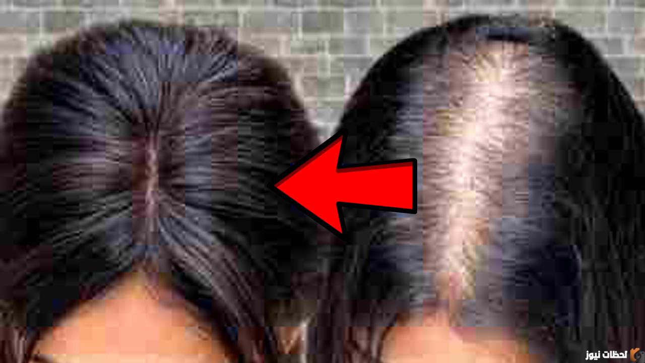 تكثيف وإنبات فراغات الشعر بأسرع الطرق
