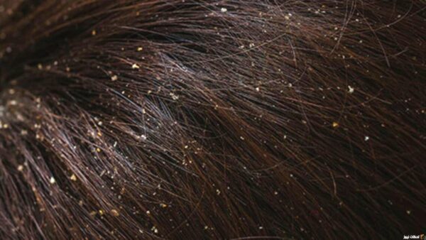 أفضل شامبو للقشرة والحكة في مصر 2023 افضل شامبو للقشرة