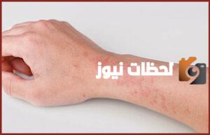 افضل دكتور جلدية بالرياض للاكزيما