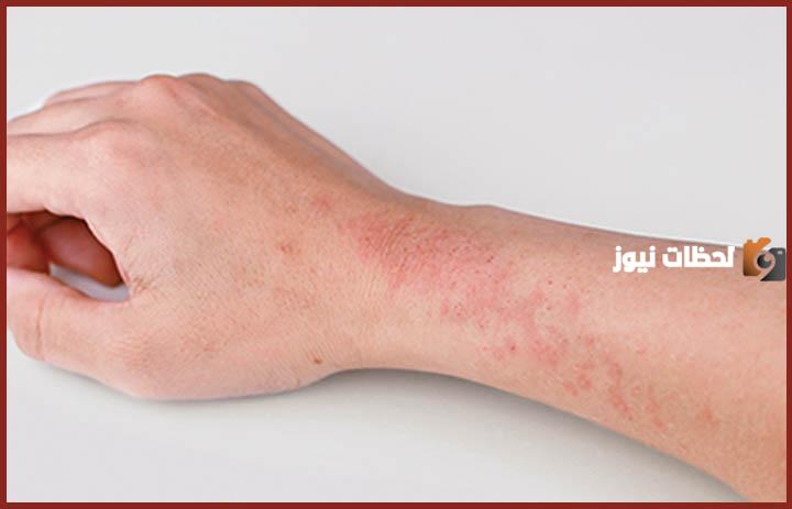 افضل دكتور جلدية بالرياض للاكزيما