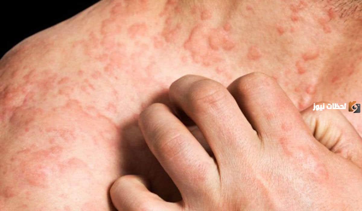 ظهور بقع حمراء على البطن والصدر بدون حكة