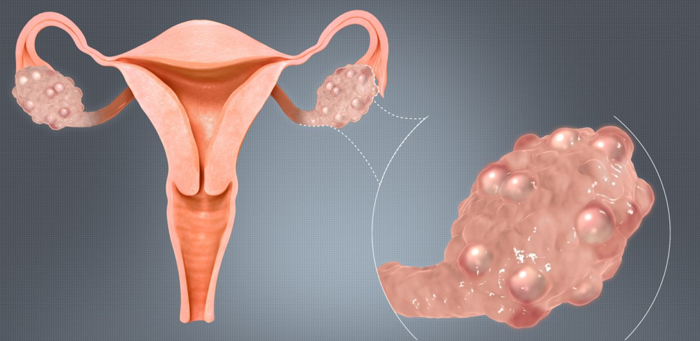 كيس مائي على المبيض حجمه 4 سم هل هو خطير؟