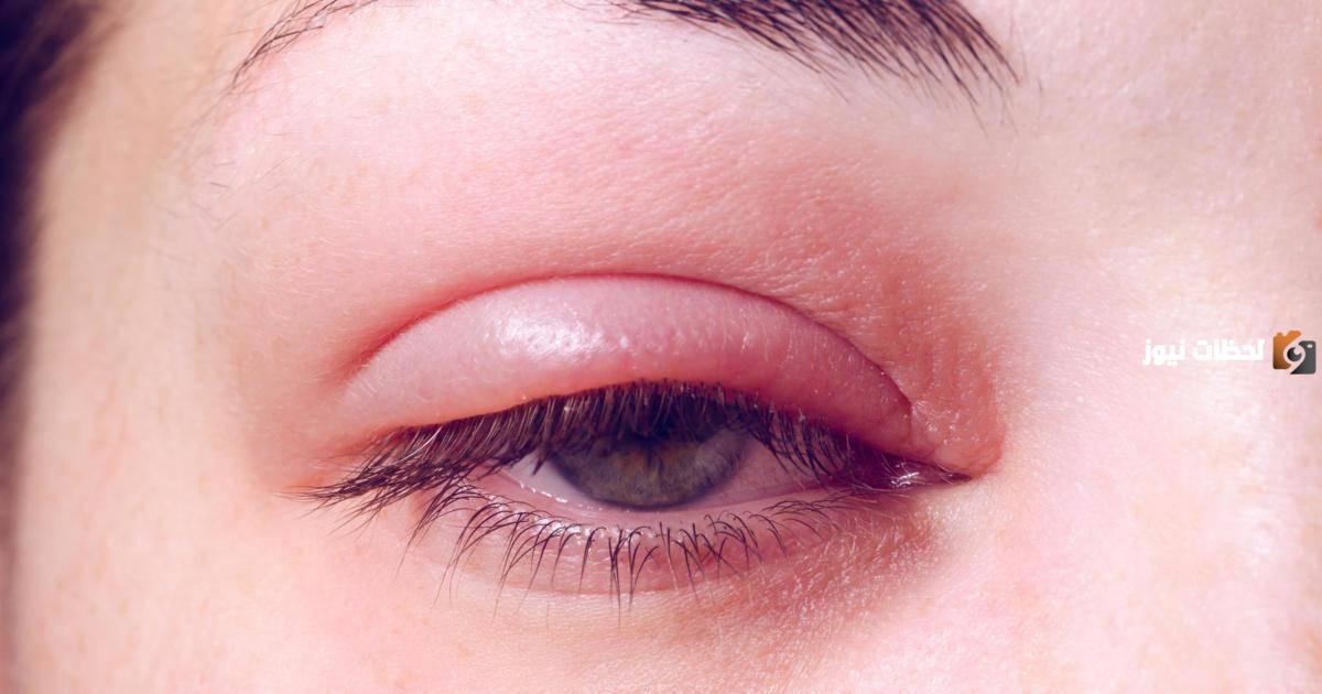 ما سبب معاناتي من تورم العينين