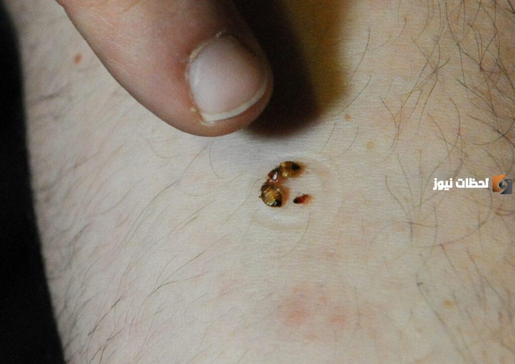 3 إجراءات لا بد من القيام بها إذا تعرضت للدغة من