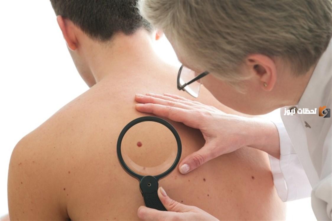 آلية علاج انتفاخ الشامة