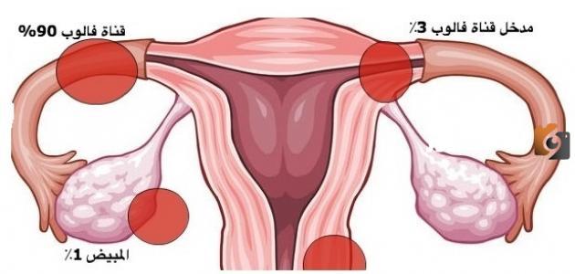 أين تذهب البويضة في حالة انسداد قناة فالوب؟
