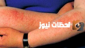 افضل دكتور جلدية بالرياض للاكزيما