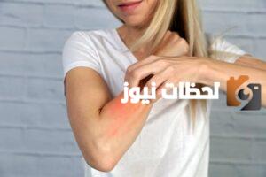 افضل دكتور حساسية جلدية بالرياض