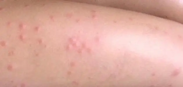 تفسير حلم الحبوب في الفخذ