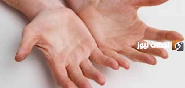 ظهور بقع صفراء على كف اليد