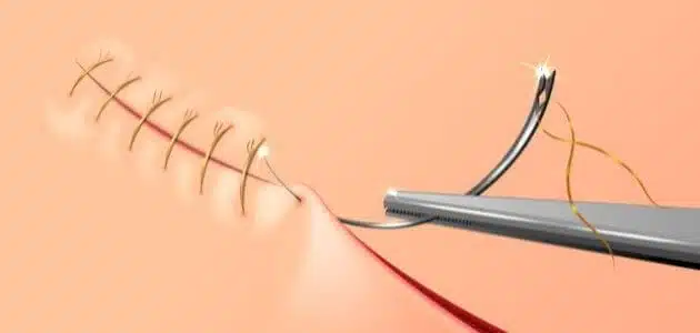 علامات تفكك خيوط الولادة