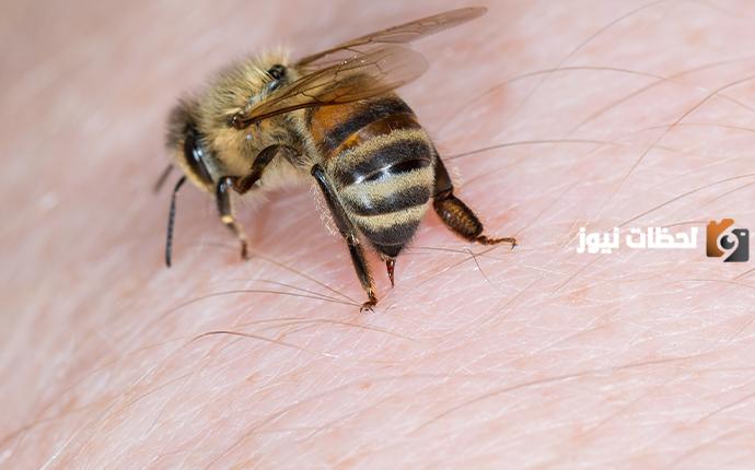 كم يدوم انتفاخ لسعة النحل
