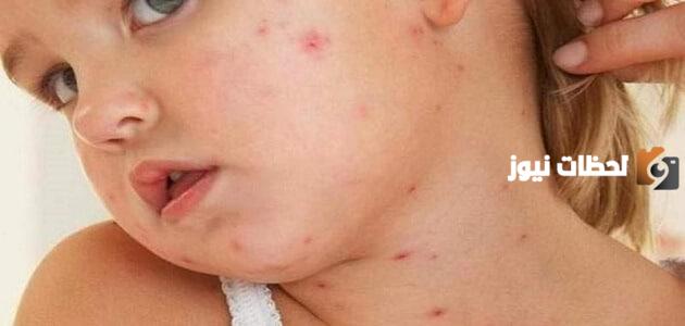 ما أسباب ظهور حبوب برؤوس مائية عند الأطفال؟