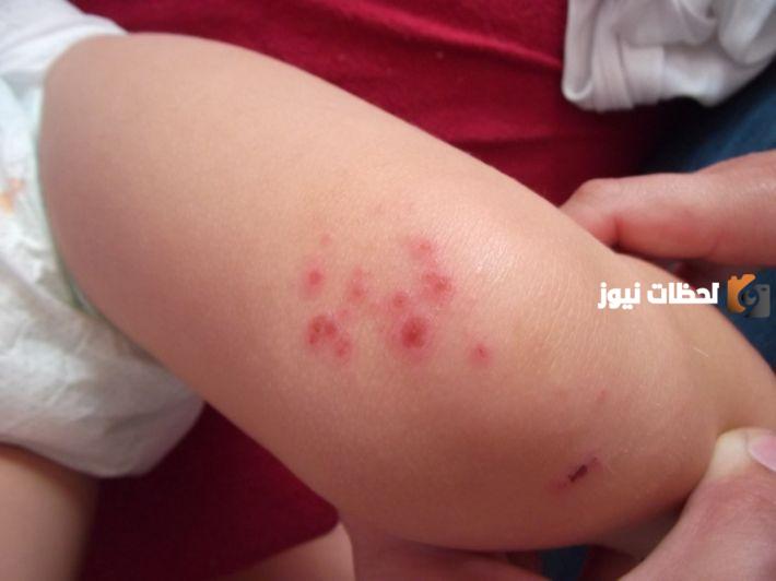 ما أسباب ظهور حبوب في اليدين والرجلين