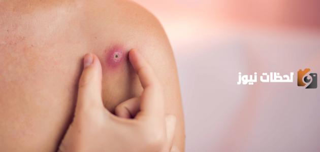 ما الفرق بين الخراج والورم