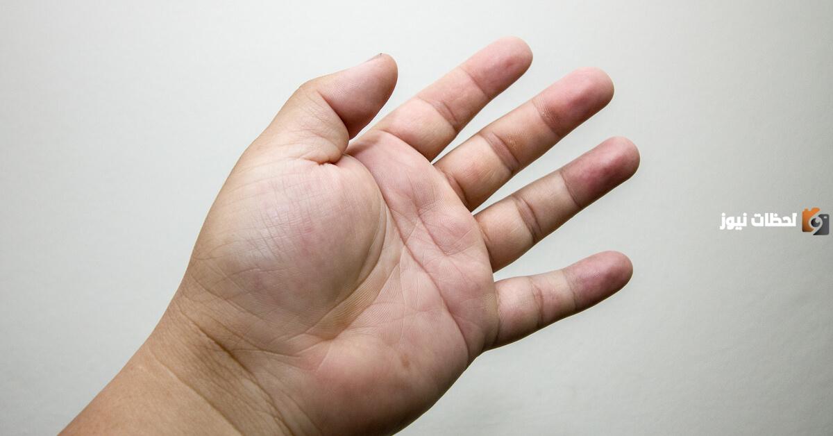 ما دلالات انتفاخ اليدين لمرضى السكري؟