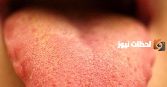 ما سبب اصفرار اللسان مع مرارة الفم معًا؟