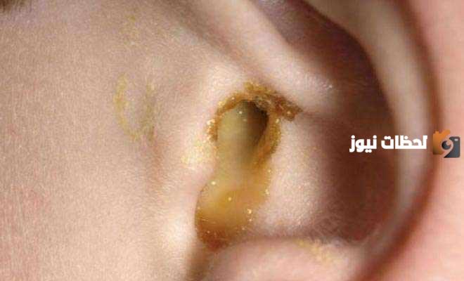 ما سبب خروج سائل أصفر من أذن الطفل؟