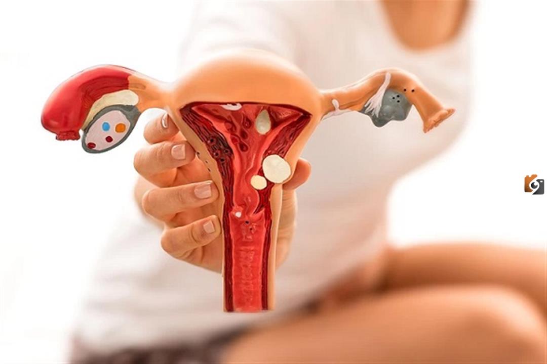 ما سبب ظهور حبة في عنق الرحم