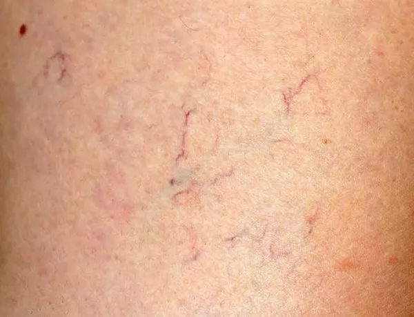 ماذا يعني ظهور عروق زرقاء في الفخذ