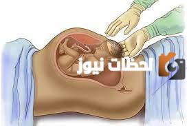 متى يقرر الطبيب الولادة القيصرية