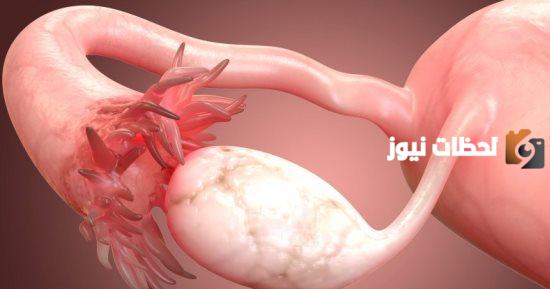 هل تكيس المبايض يسبب نزول دم؟