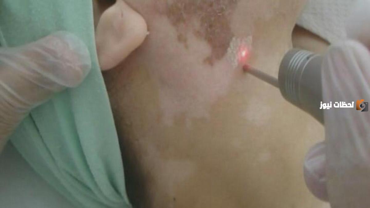 هل يؤثر إزالة الشعر بالليزر على البهاق؟