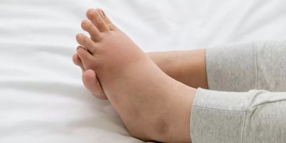 هل يوجد حالات شفيت من داء الفيل؟