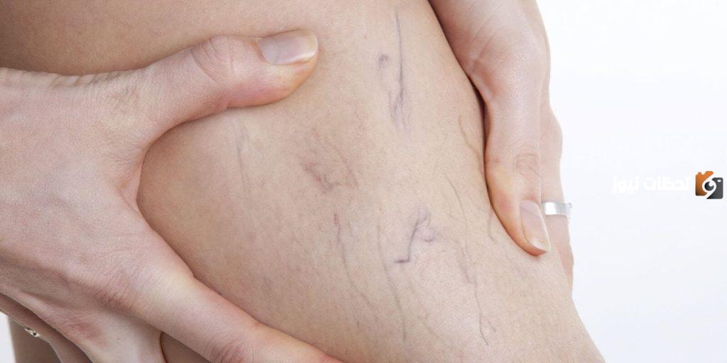 علاج الدوالي بالاعشاب
