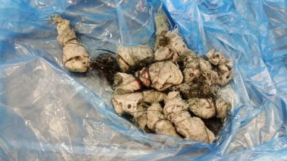 ماهي علامات خروج السحر من الجسم في المنام؟