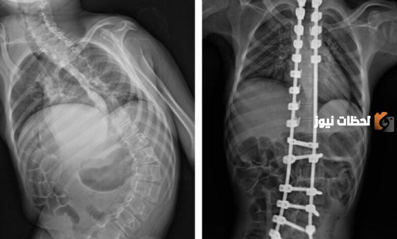 معلومات عن أفضل دكتور في مستشفى دله النخيل تخصص عظام وعمود فقري