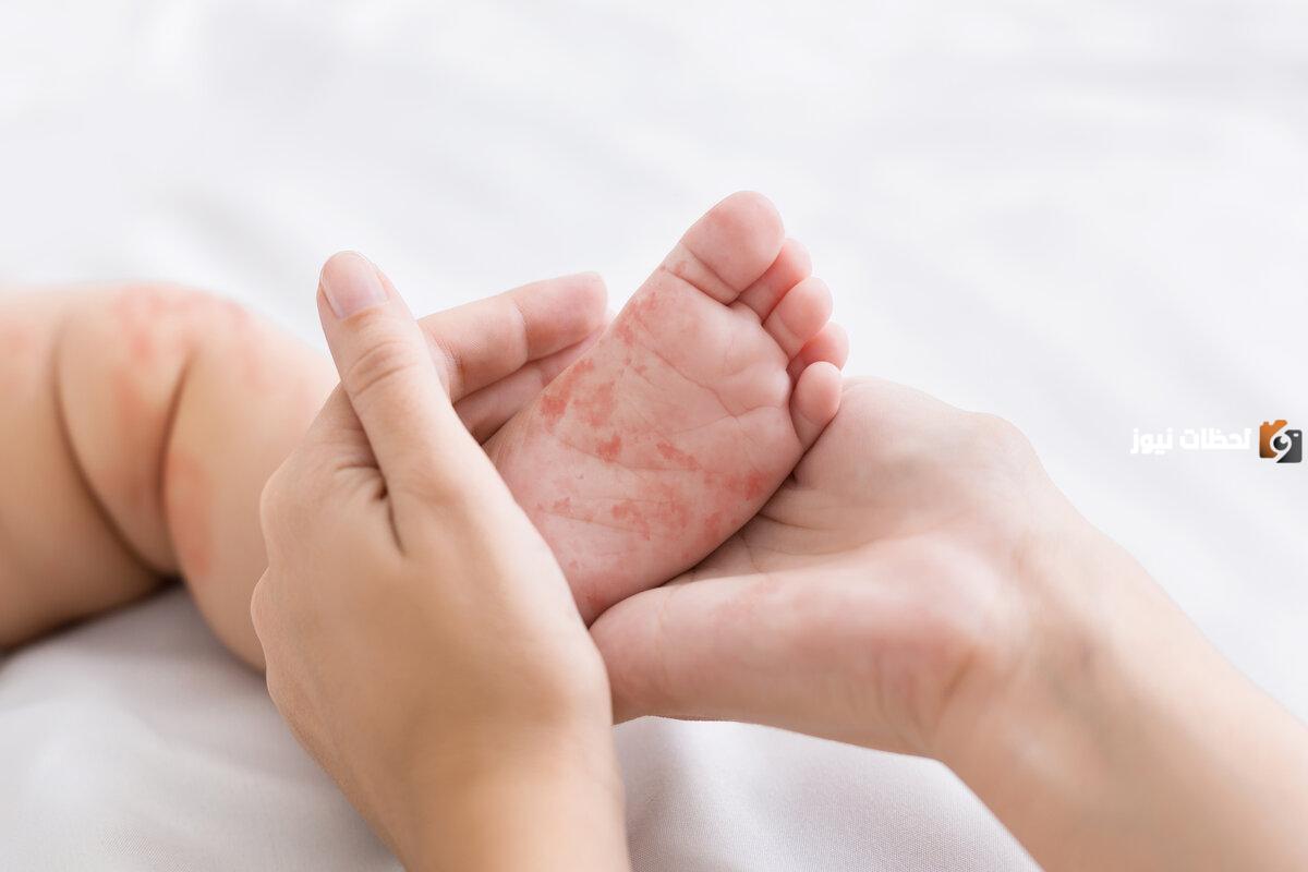 العيوب الخلقية في عظام الاطفال