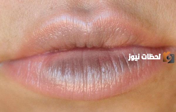 أسباب وعلاج الشفاه الزرقاء عند الأطفا