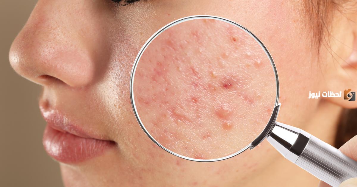 أسرع طريقة لإزالة حب الشباب