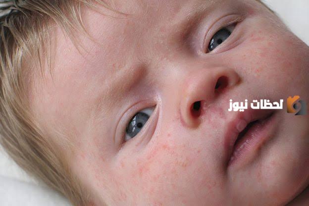 أفضل 7 علاجات منزلية فعالة لعلاج الحساسية لدى الأطفال