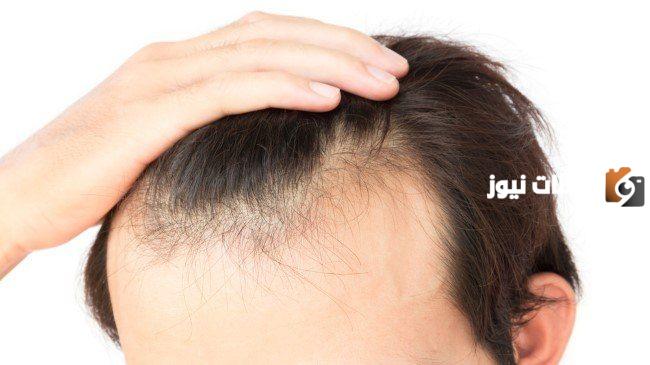 أفضل علاج فراغات الشعر في مقدمة الرأس