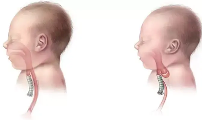اعراض رتق المريء