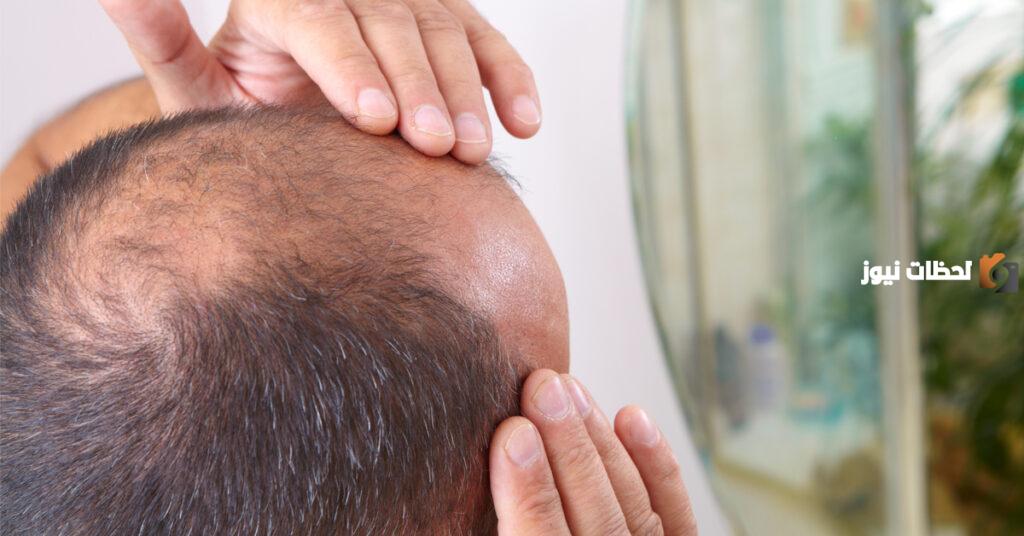اعرف كيف تعالجت من الصلع الوراثي