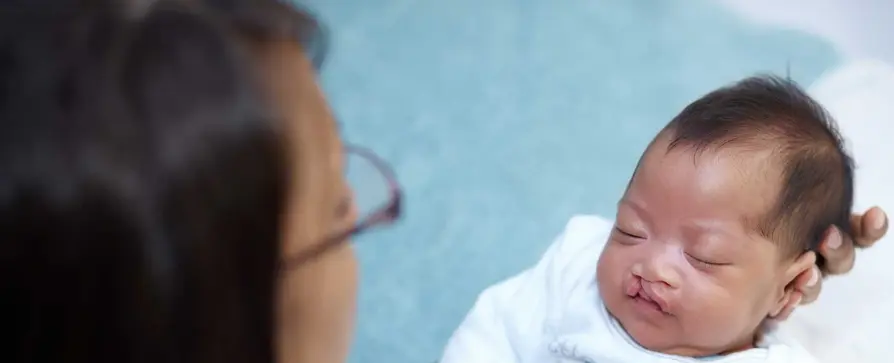 العمر المناسب لعملية الشفة الأرنبية