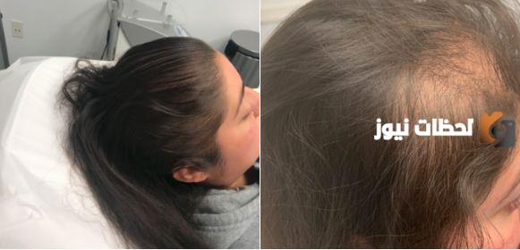 تجربتي في علاج صدفية الشعر بالليزر