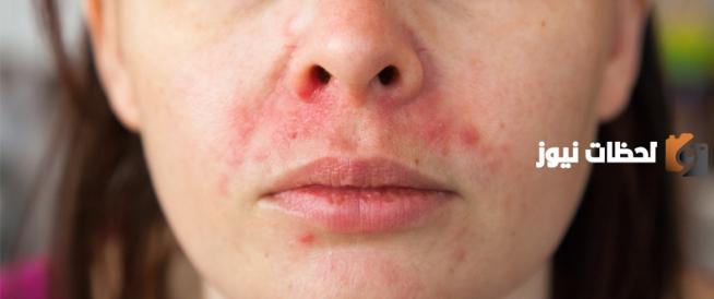 طريقة علاج حساسية الوجه بالمواد الطبيعية في المنزل