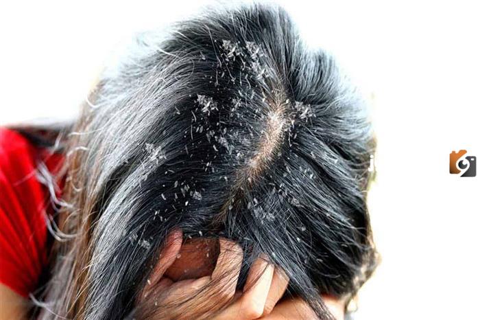 علاج قشرة سميكة في فروة الرأس