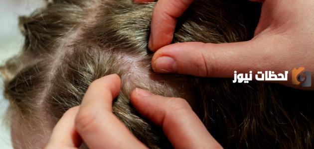 كيف اطلع الصيبان من شعري.. وصفات طبيعية