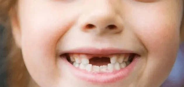كيفية التعامل مع تسوس الأسنان