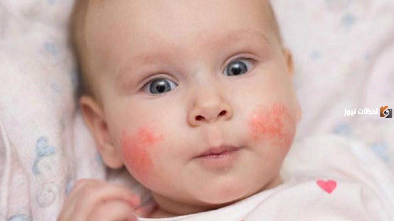 ما العلاقة بين الإكزيما عند الأطفال والحساسية أو الربو