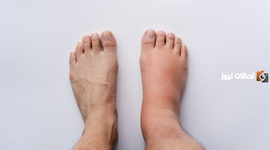 ما سبب انتفاخ القدم اليمنى بدون ألم