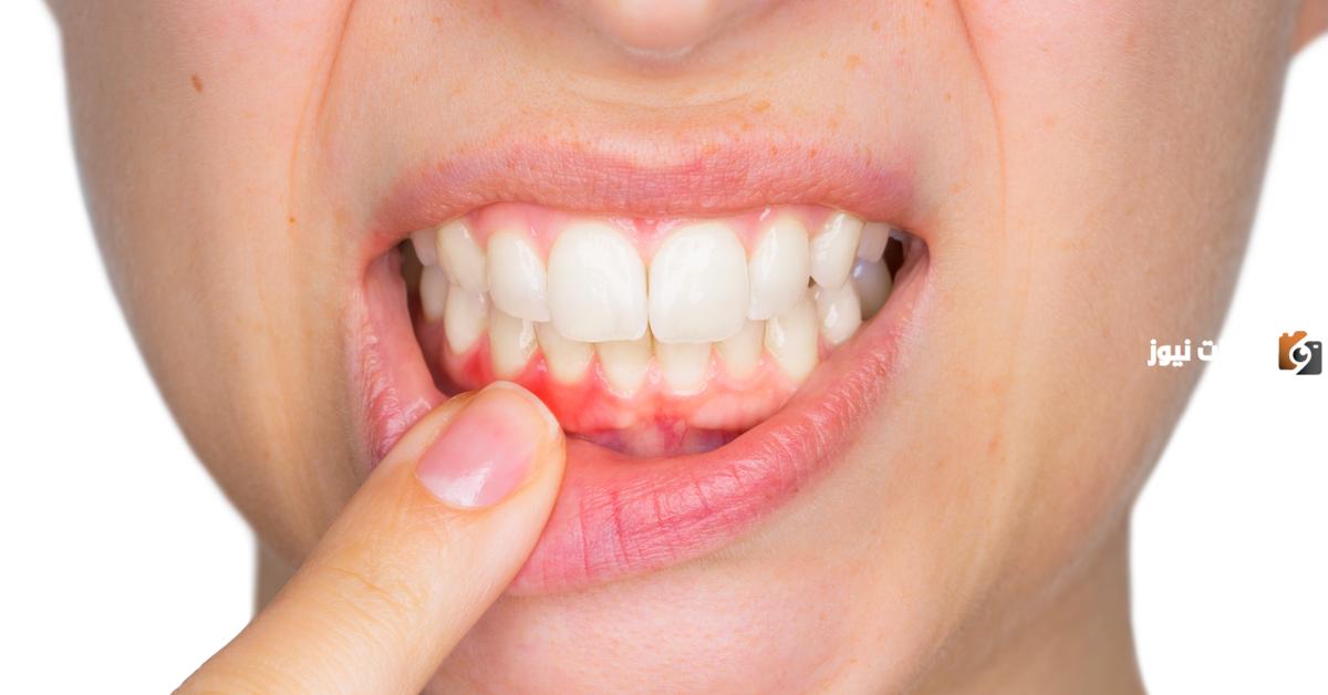 ما هو التهاب اللثة عند الأطفال Gingivostomatitis