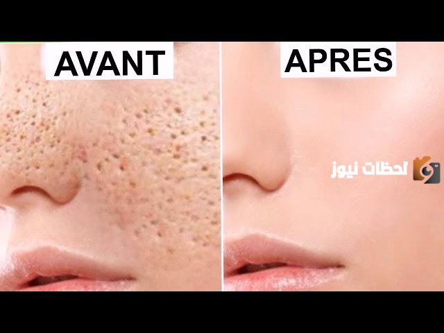 ما هو علاج المسامات من الصيدلية