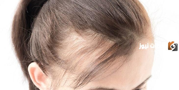 ما هى طريقة علاج صلع النساء من الأمام